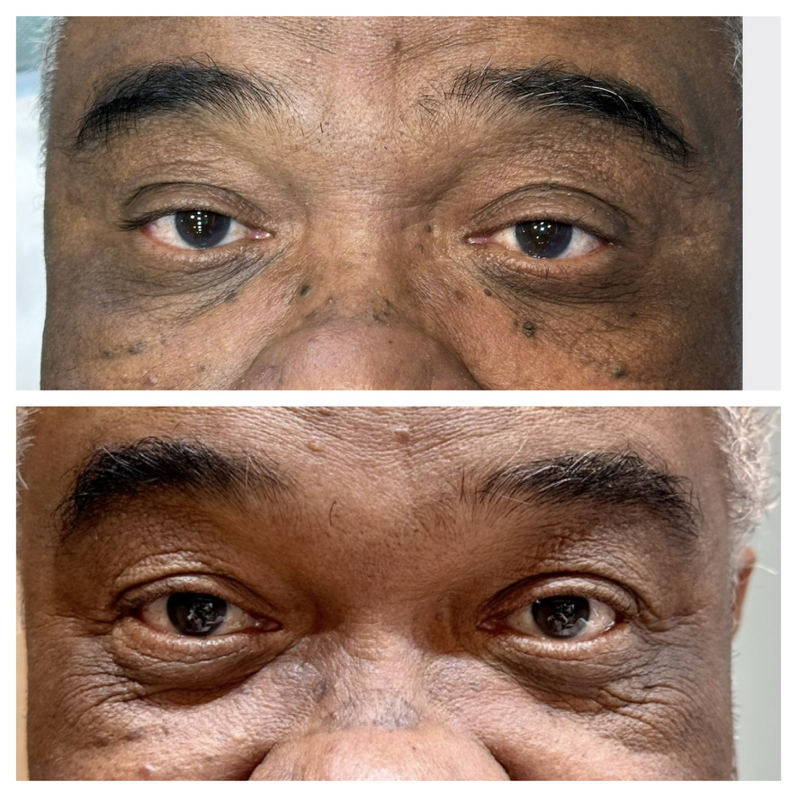 Acrocórdons na face