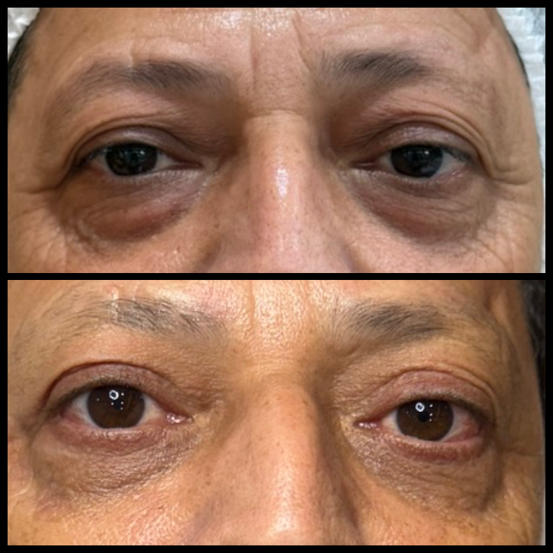 Registro de outro paciente de blefaroplastia, utilizado com autorização para finalidade educativa