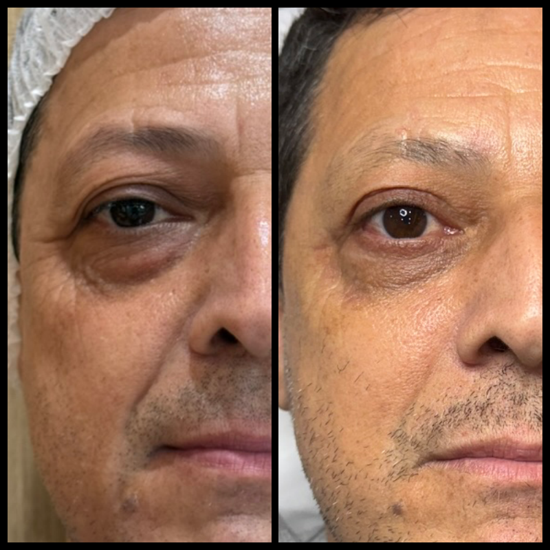 Registro lateral de blefaroplastia, utilizado com autorização para finalidade educativa