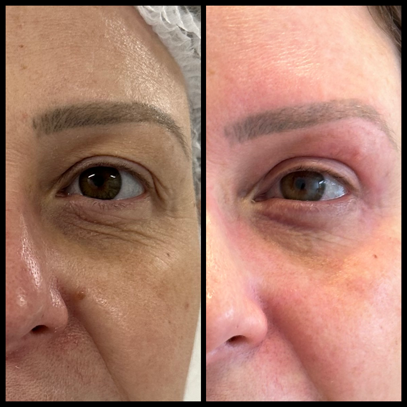 Registro clínico aproximado de blefaroplastia, utilizado com autorização para finalidade educativa