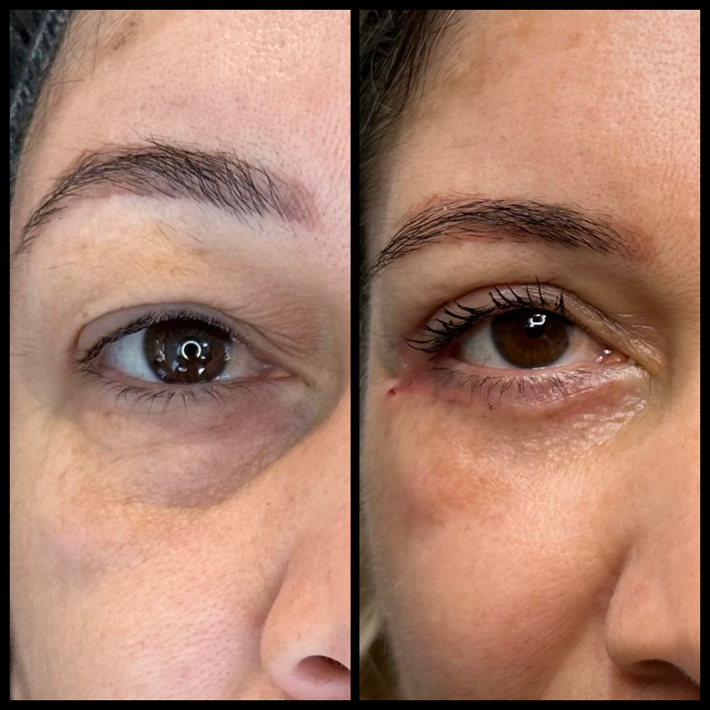 Registro clínico frontal aproximado de blefaroplastia, utilizado com autorização para finalidade educativa