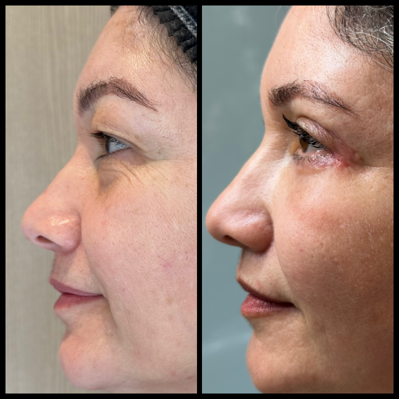 Registro clínico lateral de blefaroplastia, utilizado com autorização para finalidade educativa