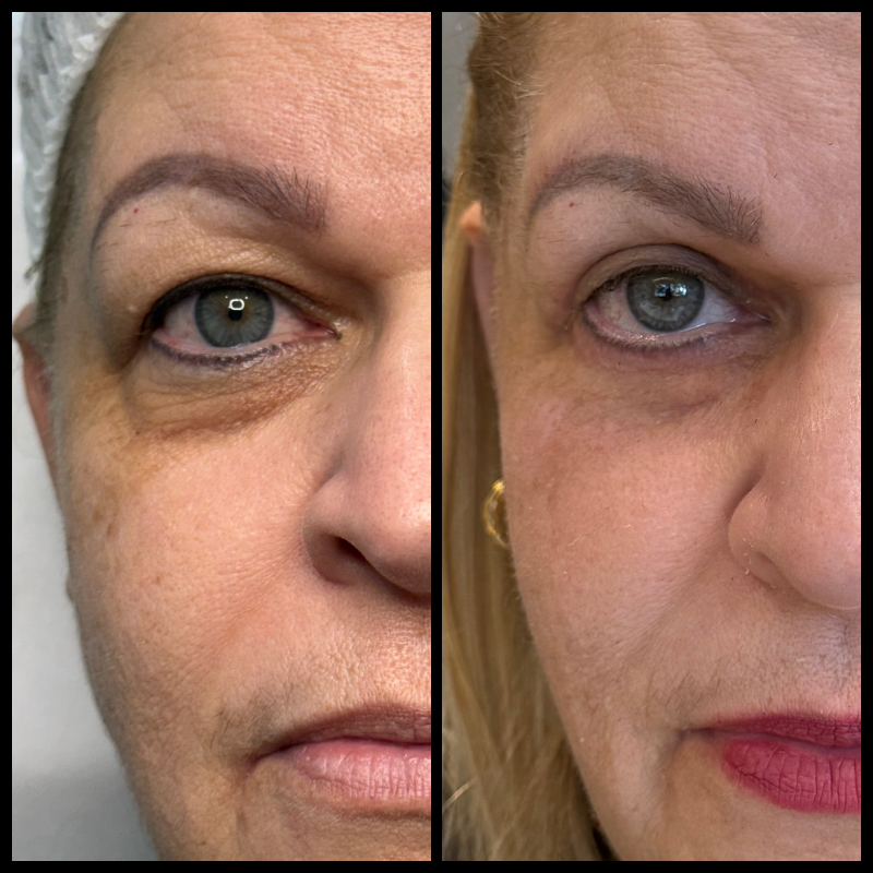 Registro clínico frontal de blefaroplastia, utilizado com autorização para finalidade educativa