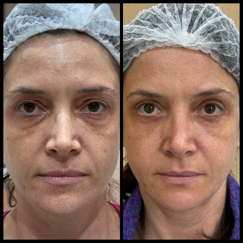 Registro clínico frontal de blefaroplastia, utilizado com autorização para finalidade educativa