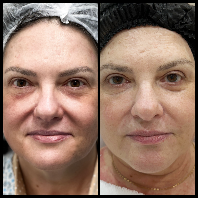 Outro registro clínico de blefaroplastia, utilizado com autorização para finalidade educativa