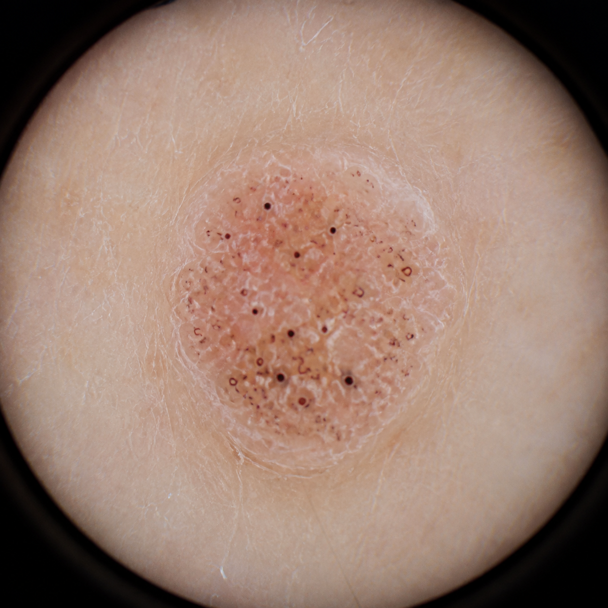 Simulação dermatoscópica de verruga vulgar com pontos vasculares e interrupção das linhas da pele