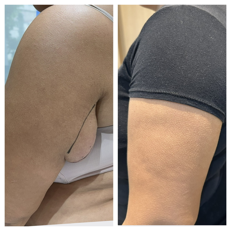 Lipoma no braço