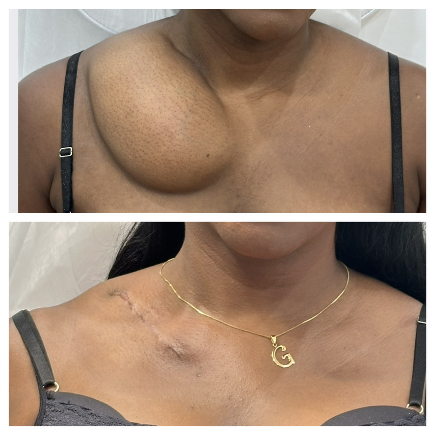 Registro clínico de lipoma na região do tórax, em comparação de acompanhamento