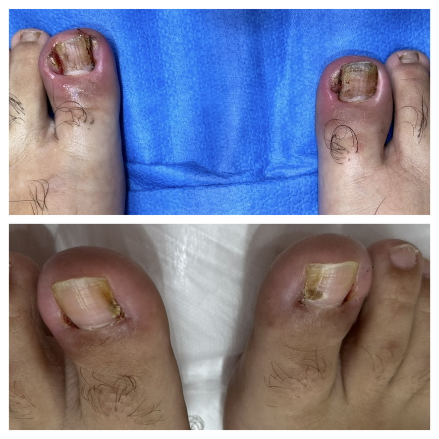 Registro clínico de unhas encravadas e acompanhamento