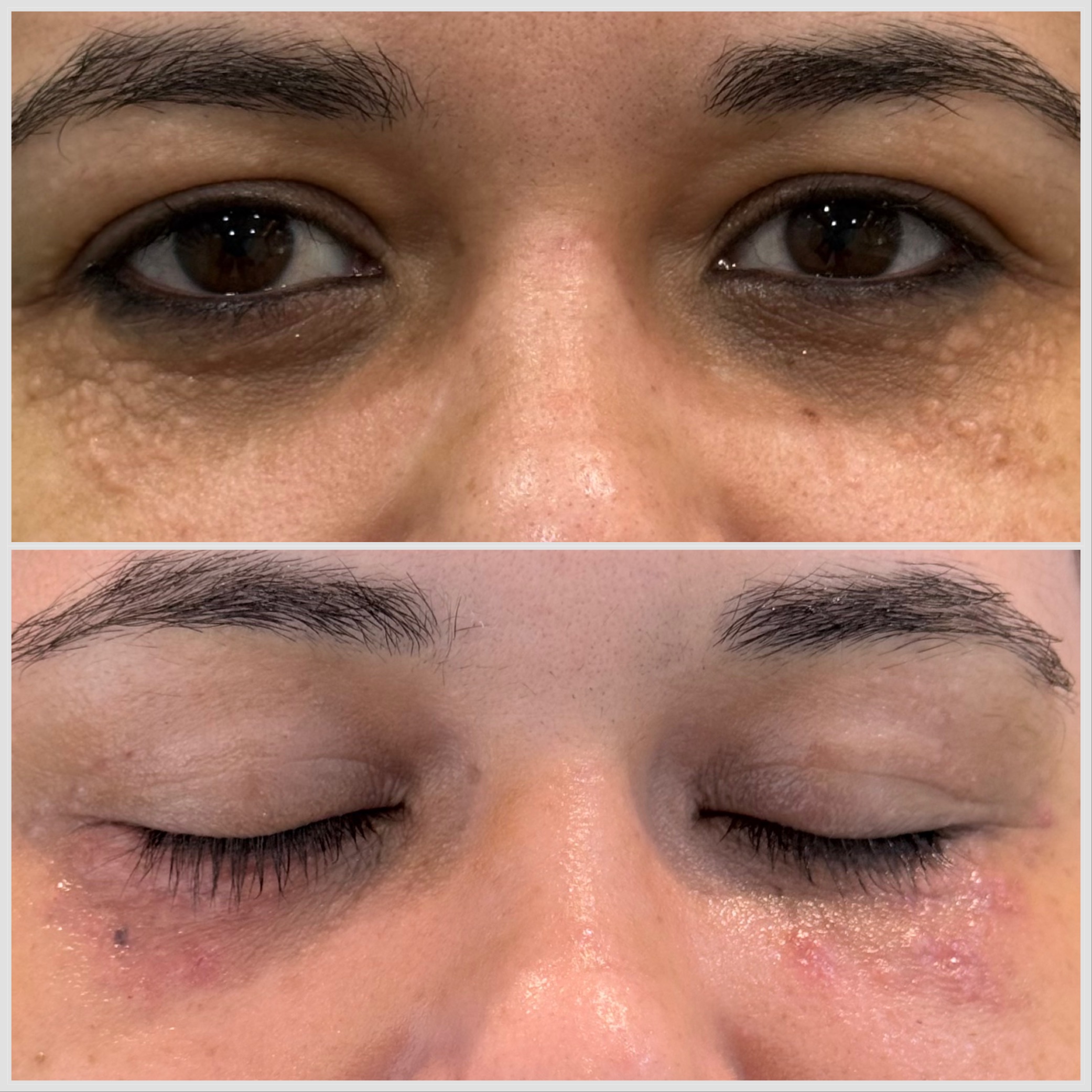Xantelasma na região periocular